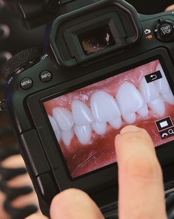 How Much Do Veneers Cost? US Prices Per Tooth & Full Set (2026)
